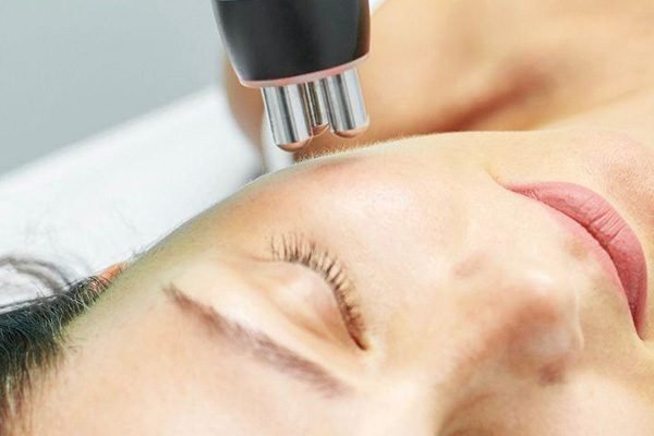 radiofrecuencia-facial