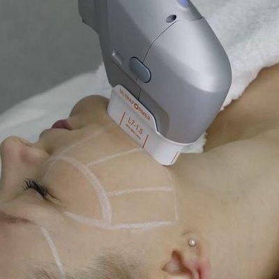rejuvenecimiento-facial-con-laser