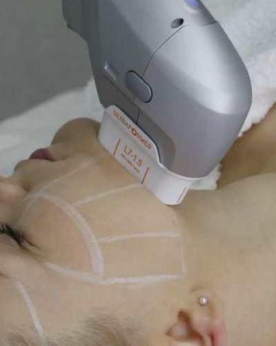 rejuvenecimiento-facial-con-laser