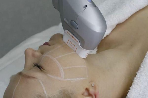 rejuvenecimiento-facial-con-laser